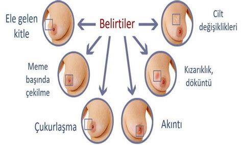 Meme Kanseri Meme Kanser Belirtiler Doktortakvimi