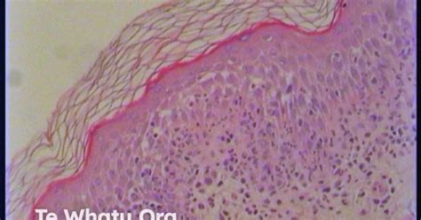 DermNet® - Pathology of toxic epidermal necrolysis image