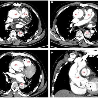 Pdf Case Report Simultaneous Ascending Aortic Dissection And