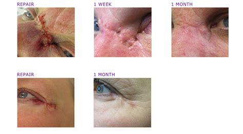 Mohs Surgery Photos Before And After Adc Derm