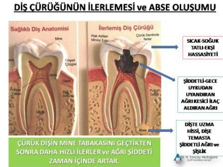 Di A R S Nedenleri Di Hekimi Tuncay Akdo Anl Ankara