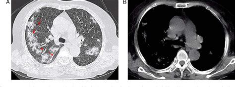 Figure 1 From Primary Pulmonary Intravascular Large B‑cell Lymphoma Misdiagnosed As Pneumonia