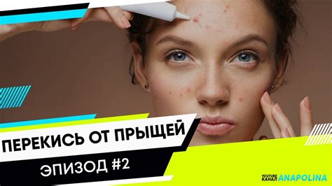 Перекись от прыщей. Применение перекиси водорода от прыщей. Самое ...