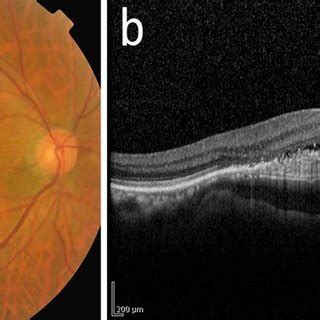 Fundus Photograph And Oct Image Of The Same Patient With Namd A Fundus