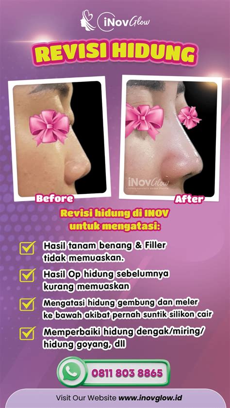 Before After Operasi Hidung Inovglow Klinik Spesialis Bedah Plastik