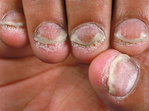 8 Ways Psoriatic Arthritis Affects The Nails Goodrx