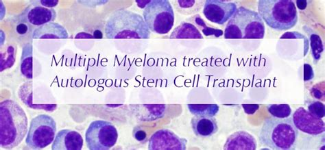 Multiple Myeloma Treated With Autologous Stem Cell Transplant