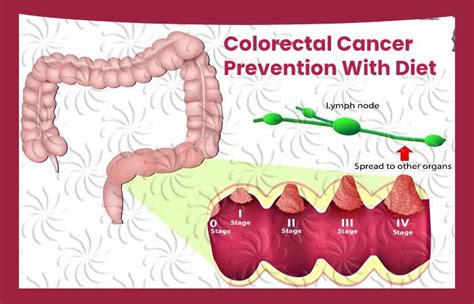 High Fat Diet And Risk Of Colorectal Cancer