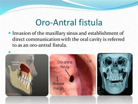 Maxillary Sinuspptx Gaurav