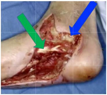 Dpt Management Of Integumentary Disorders Exam I Part Iii