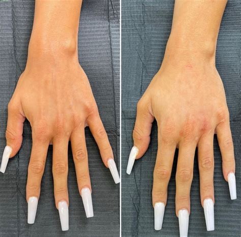 Hand Filler The Flawless Lab Scottsdale Arizona