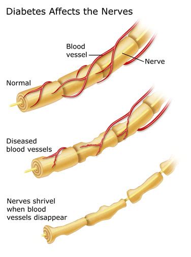 Nerve Damage Can Sometimes Be Reversed Health Clover