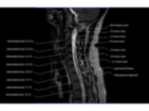 Solution Mri Cervical Spine Sagittal Studypool