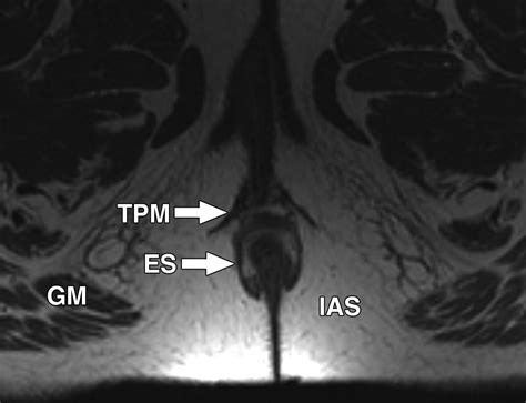 Normal Anal Sphincter