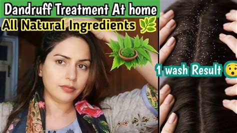 How To Get Rid Of Dandruff Permanently At Home Effective Home Remedy