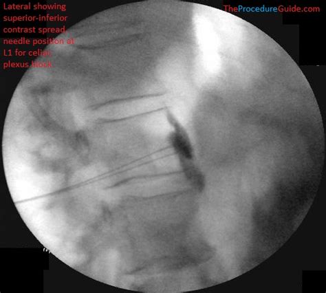 Celiac Plexus Block Technique