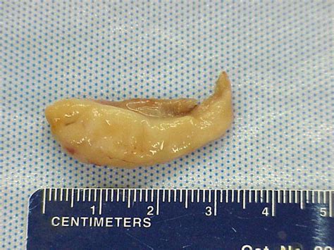 Endoscopic Removal Of Nasal Polyps In A Cat Using A Novel Surgical Approach Meredith L