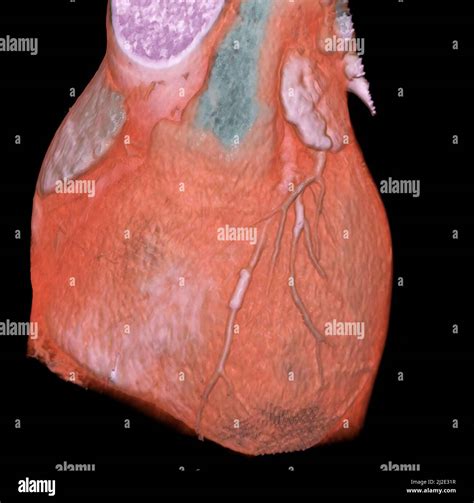 Coronary Stent Hi Res Stock Photography And Images Alamy