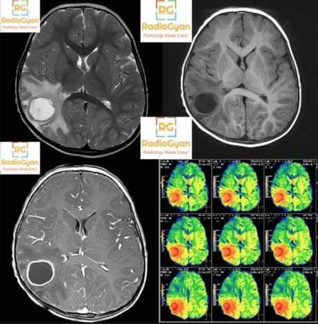 Radiology Cases Excellent Neuroradiology Cases Radiogyan