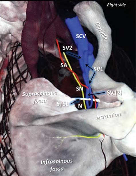 Figure 1 From An Unusual Bilateral Duplication Of The Suprascapular