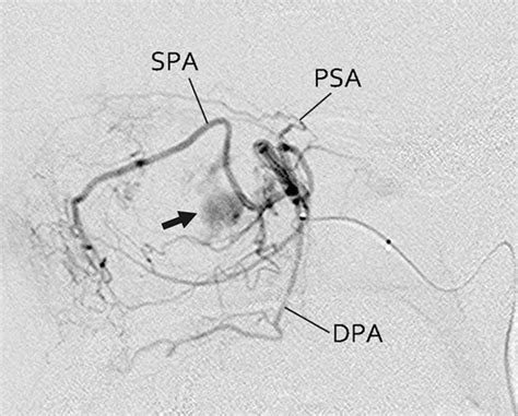 Sphenopalatine Artery Anatomy