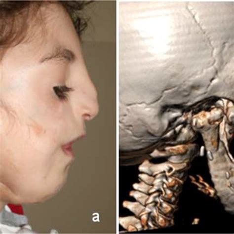 CT scan before (a); during bidirectional mandibular distraction, the ...