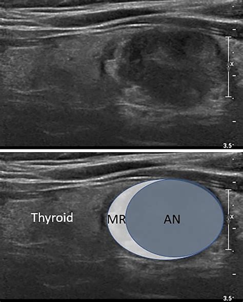 Thyroid Nodule Radiofrequency Ablation Complications And Clinical