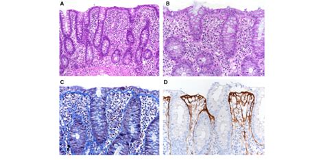 Histology Of The Right Colon Showing Preserved Mucosal Architecture