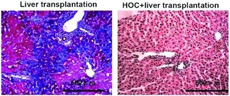 Histological Examination Of Liver Allograft Rejection Sections