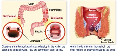 When Your Colonoscopy Reveals That You Have Diverticulosis Hemorrhoids Or Both Harvard Health