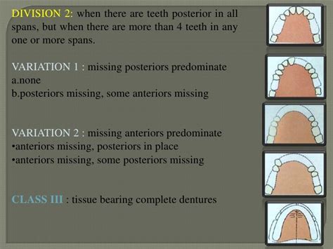 Classification Of Rpd