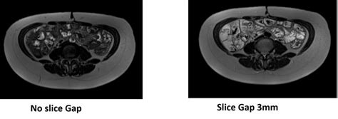 Cross Talk Artifact Mri Cross Excitation Or Slice Overlap Artifact