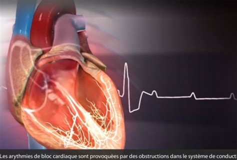 Pathologies Cardiaque Flashcards Quizlet