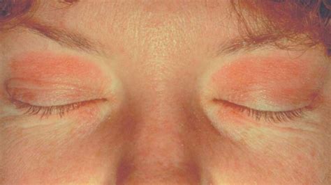 Contact Dermatitis Eyelid Symptoms Causes And Treatment Health 24