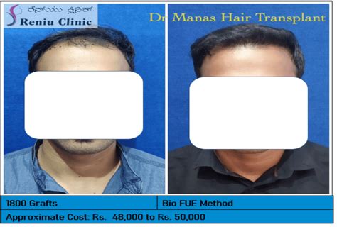 Best Hair Transplant In Mysore Reniu Clinic