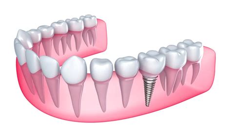 4 choses à avoir en tête avant de se faire poser des implants dentaires