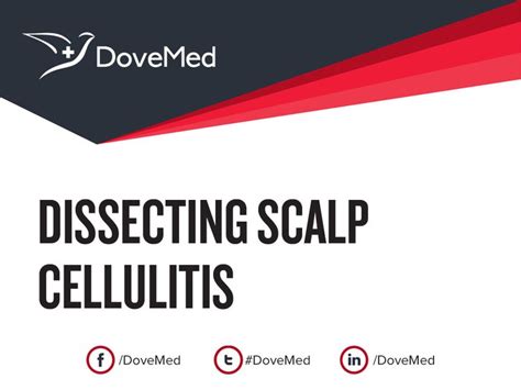 Dissecting Scalp Cellulitis