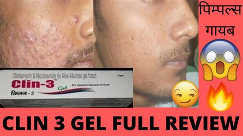 Clin 3 Gel Full Review Effects And Side Effects Best For Acne And