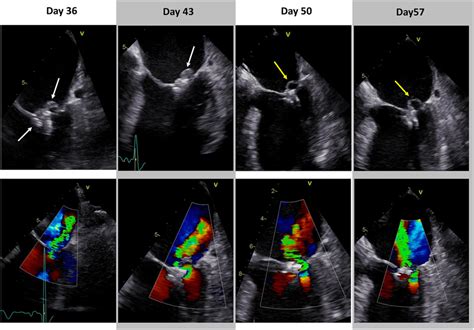 Progress Of Infective Endocarditis In Transesophageal Echocardiography Download Scientific