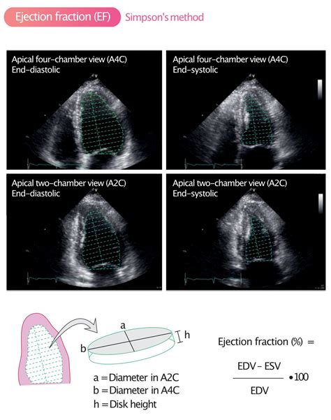 Linksventrikuläre Ejektionsfraktion EKG ECHO