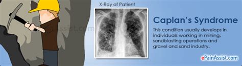 Caplan Syndromewhat To Know