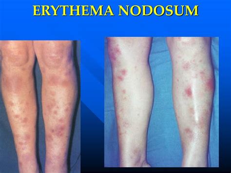 Erythema Nodosum Sarcoidosis