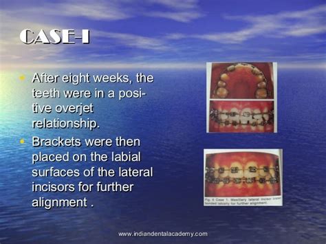 Alignment Of Blocked Out Maxillary Lateral Incisors Jcojuly2000