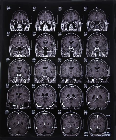 MRI scan image of brain. For diagnosis #Sponsored , #PAID, #ad, #scan, #brain, #image, #MRI ...