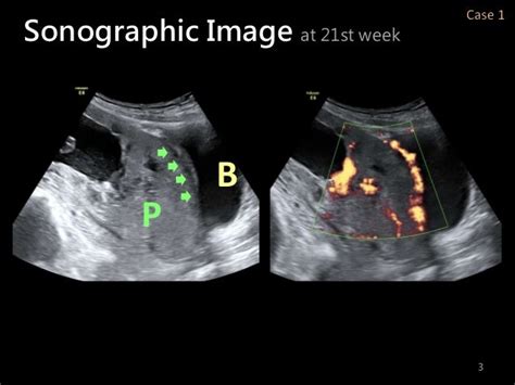 Morbidly Adherent Placenta For Apan39