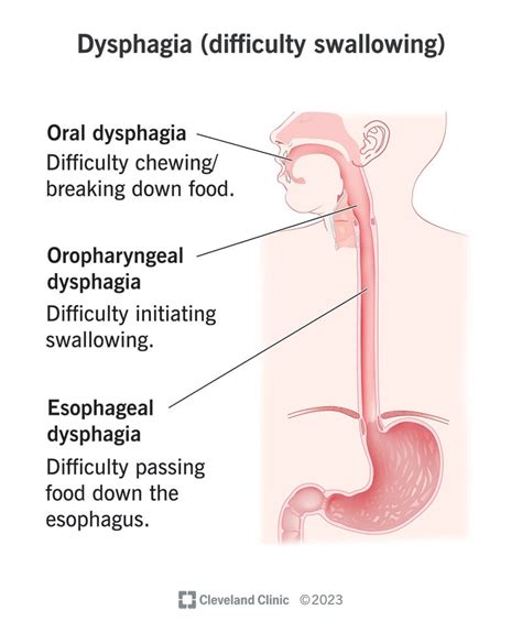 Understanding Dysphagia Causes Symptoms And Treatment Ask The Nurse Expert