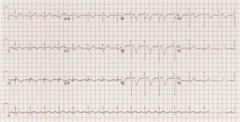 Right Ventricular Strain • LITFL • ECG Library Diagnosis