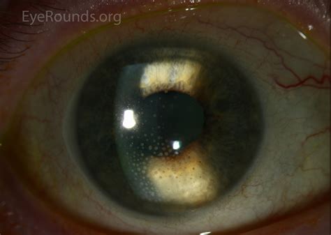 Atlas Entry - Mutton-Fat Keratic Precipitates (KP)