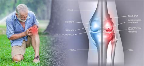 Best Ways To Reduce Knee Pain Caused By Osteoarthritis Everyday Medical