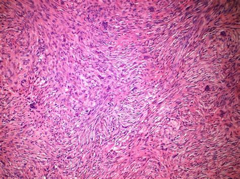 Fibroma Pathophysiology Wikidoc